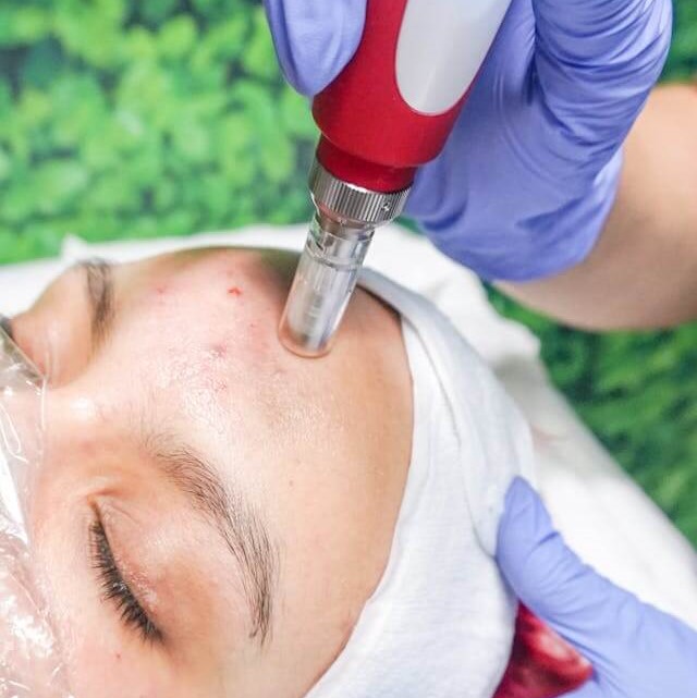 Mesoterapia sinagujas