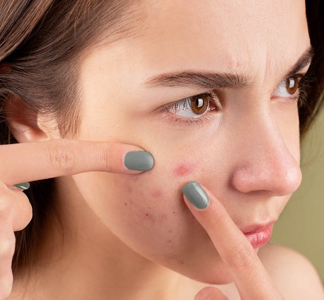 tratamiento anti acne
